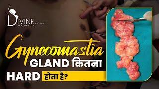 Gynecomastia Gland कितना Hard होता है?