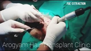 FUE extraction at Arogyam Hair Transplant Clinic Guwahati  ||  Blunt Motorized FUE extraction