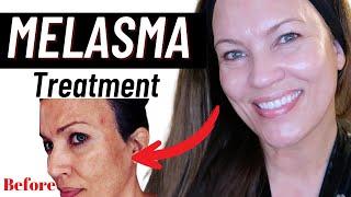 MELASMA TREATMENT at HOME!!! FADE DARK SPOTS, HYPERPIGMENTATION, MELASMA!