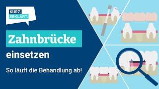 Zahnbrücke einsetzen: So läuft die Behandlung ab!