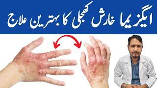 Magical Remedy For Eczema - Irfan Azeem