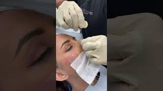 Check Out This Amazing PDO Nose Bridge Treatment - Ageless MD