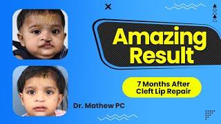 Amazing Result - 7 Months After Cleft Lip Surgery | Undergoes Cleft Palate Surgery In India