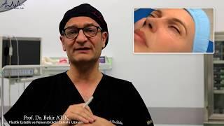 MID-FACE LIFT - PROF. DR. BEKİR ATİK