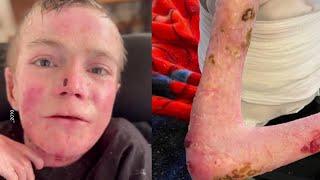 TikToker Dies of Rare Genetic Disease That Causes Skin to Blister