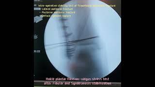 S16.Intra-op. Syndesmosis/Deltoid ligament stability test in Trimalleolar equivalent fracture[강함정이]