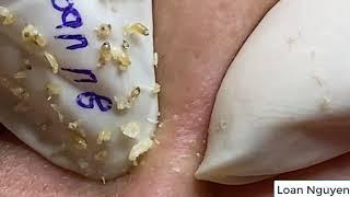 BLACKHEADS extraction n8 | Loan Nguyen