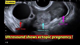 Ectopic Pregnancy | Ultrasound case