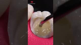 How to remove cavity from tooth #Shorts