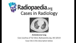 Amiodarone lung (Radiopaedia.org) Cases in Radiology