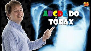 COMO AVALIAR QUALQUER RAIO X DO TÓRAX COM SEGURANÇA? O ABCDE DO TÓRAX I VOCÊ RADIOLOGISTA