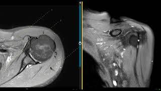 Shoulder pain in 26 year old. No trauma.