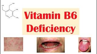 Vitamin B6 (Pyridoxine) Deficiency | Dietary Sources, Causes, Signs & Symptoms, Diagnosis, Treatment