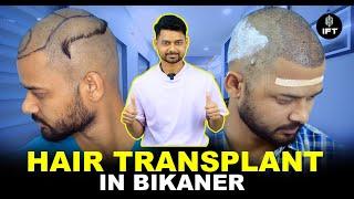 Hair Transplant in Bikaner | Cost of Hair Transplant in Bikaner | IFT Hair Science