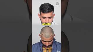 Thirty Months Hair Transplant Results | Latest Fue Technique #shorts #viral #hair transplant