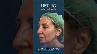 Resultado antes y después de cirugía plástica de LIFTING por el Dr. Rubí