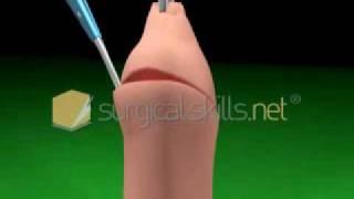 Medical Gallery- Circumcision Video 3D