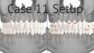 Maestro 3D aligners virtual setup: case 11, moderate crowding of the incisors