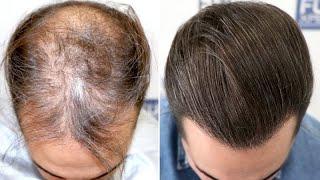 FUE Hair Transplant (3586 Grafts NW V Vertex) by Dr Juan Couto - FUEXPERT CLINIC - Madrid, Spain