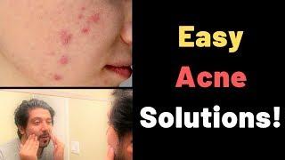 Acne Remedies | Acne Solutions | How To Get Rid of Acne