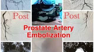 TREATMENT OF ENLARGED PROSTATE WITHOUT SURGERY