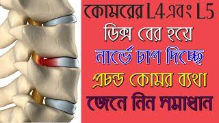 কোমরের এল ৪ , এল ৫ এ ব্যথা ! জেনে নিন সঠিক চিকিৎসা/ L4 L5 disc bulge treatment without surgery