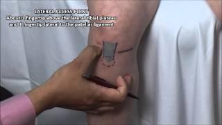 Knee Injection - Anterior Approach