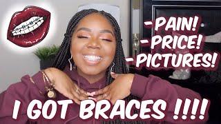 ALL ABOUT MY BRACES 