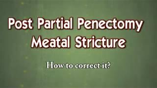 Reconstruction of post partial penectomy meatal stricture