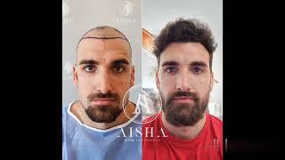 Aisha Hair Transplant - 3600 grafts FUE