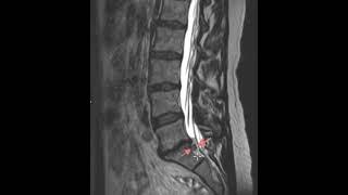 Don't miss this disc herniation