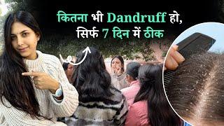 सिर्फ़ 7 दिन में Dandruff का Permanent Solution | सर्दियों में Dandruff रोकने के लिये घरेलू उपाय