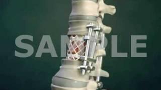 Thoracolumbar Spinal Fusion: 3D Medical Animation