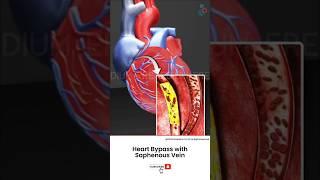 How Does Heart Bypass Surgery Work? ↪ 3D Medical Animation #Shorts #SaphenousVein