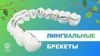  Лингвальные брекеты