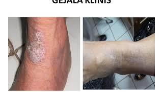 NEURODERMATITIS | Materi Kedokteran | Dermatologi