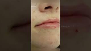 How Lip Fillers Look on Thin Lips