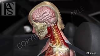 Car Accident Neck and Spine Injury