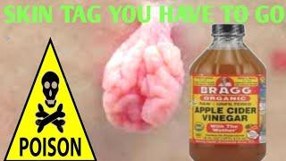 How To Remove A Skin Tag Using Apple Cider Vinegar