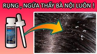 Kinh Nghiệm Loại Bỏ Vảy Gàu do Minoxidil Gây Ra | Tóc Nhiều Đẹp Trai #19