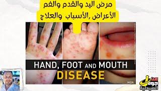 HAND FOOT AND MOUTH   مرض اليد والقدم والفم - الأعراض والأسباب والعلاج