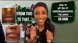 How To Get Rid Of Hyperpigmentation! | Dr Hani