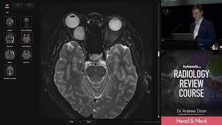 Orbital Cavernous Malformation - Radiology Review Course