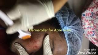 Acne Scar Treatment in Delhi, India|Dermaroller treatment in Delhi & Gurgaon