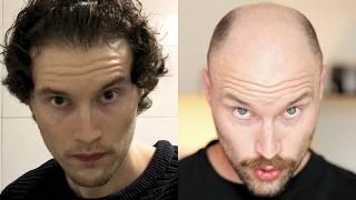 BALDING YEAR 1 vs YEAR 6