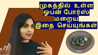 Instant OPEN PORES Removal In Tamil | Just 2 Ingredients Ayurvedic remedy | Chennai Girl In London