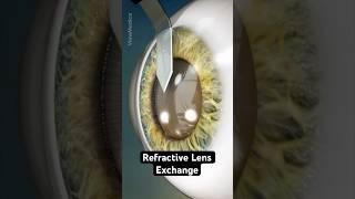 Procedure guarantees you will never have cataracts (3D Animation)