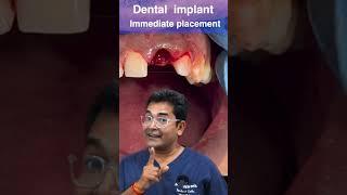 Immediate implant placement