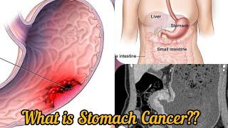 Everything about Stomach Cancer @DrAshishSachan