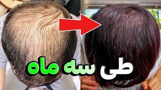 راه حل ساده و ارزان برای رشد مجدد مو  | Hair Loss Treatment